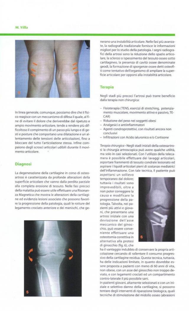 Articolo scritto dal Dottor Marco Villa sull'Artrosi dell'anca e del ginocchio