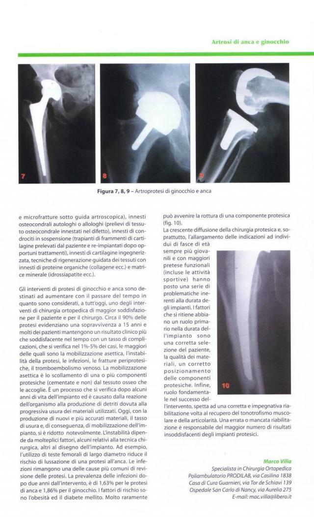 Articolo scritto dal Dottor Marco Villa sull'Artrosi dell'anca e del ginocchio