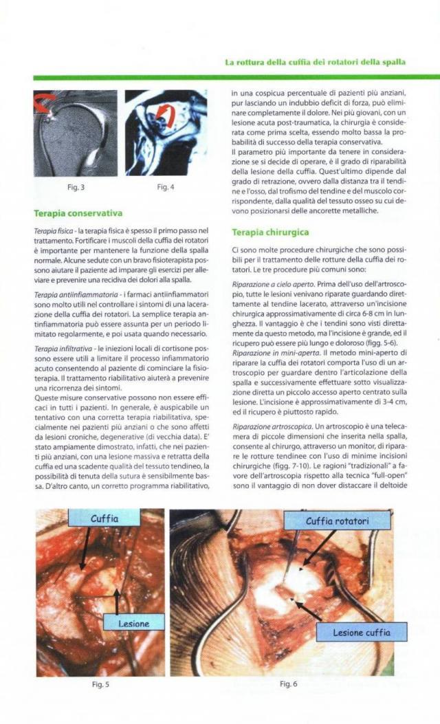 Articolo scritto dal Dottor Marco Villa sulla rottura della cuffia dei rotatori della spalla
